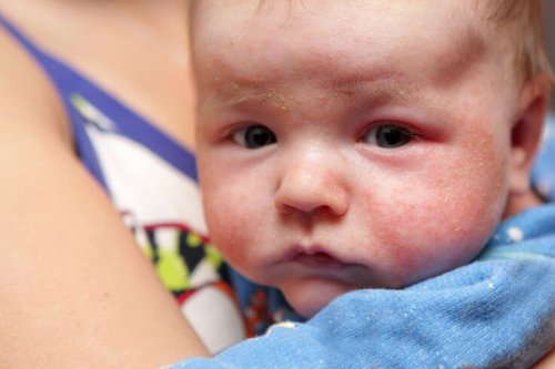 Los eczemas pueden ser causantes de las escamas en la piel del bebé.