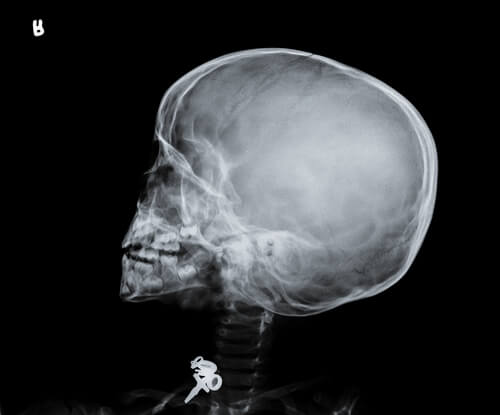 ¿Qué es el síndrome del bebé sacudido?