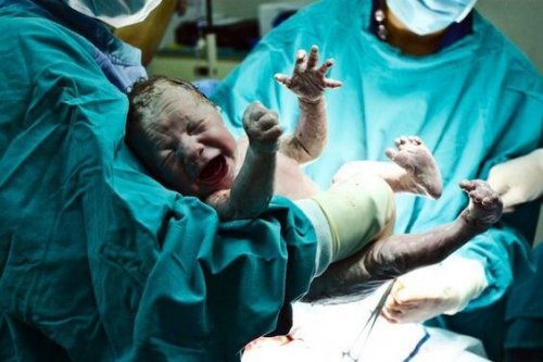 ¿Nacer por cesárea podría ser perjudicial para la salud?