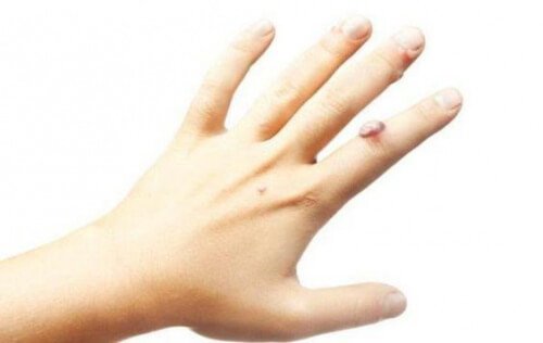 remédio caseiro para verrugas