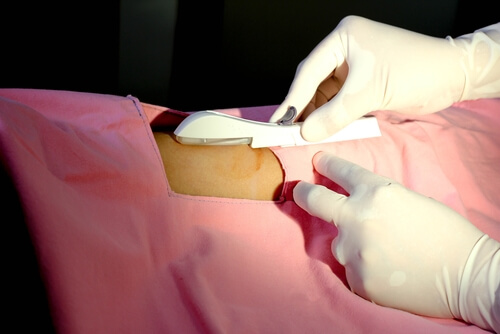 El implante de progesterona se introduce vía subcutánea y es un procedimiento ambulatorio.
