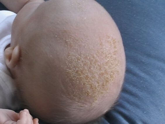 ¿Qué son esas escamas en la piel de los bebés?