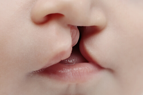 Descubre a qué edad puede operarse un niño con labio leporino