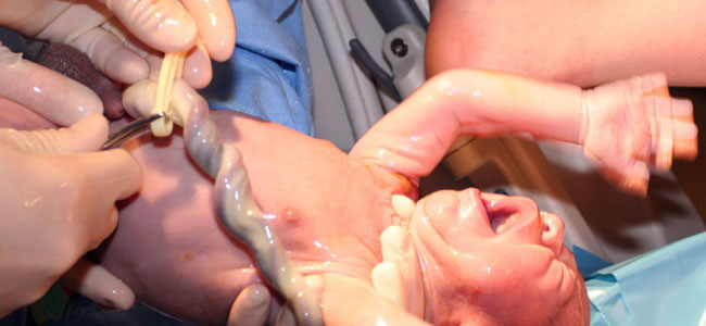 Médicos cortando o cordão umbilical do bebê.