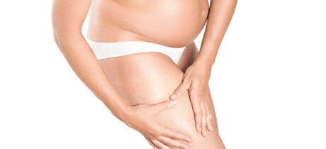 Es mejor prevenir las estrías después del embarazo mediante acciones incluso durante la gestación.