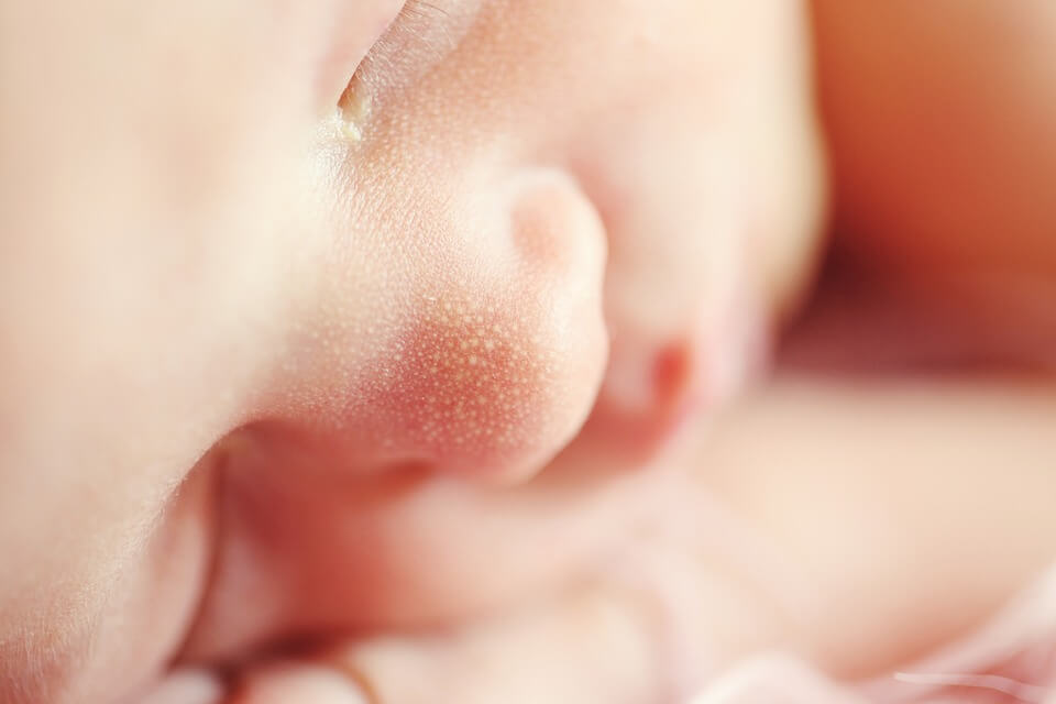 Síntomas de la dermatitis atópica infantil Síntomas de la dermatitis atópica infantil