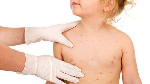 Dermatitis herpetiforme, ¿rastros de celiaquía en la piel?