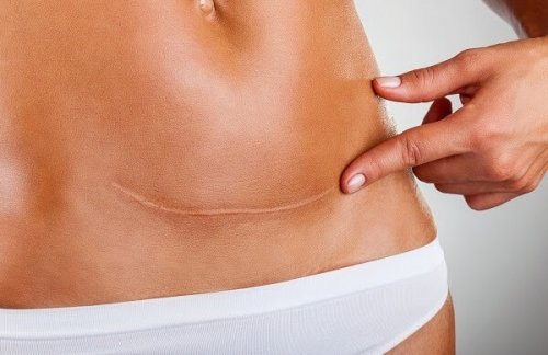 caesarean section scar