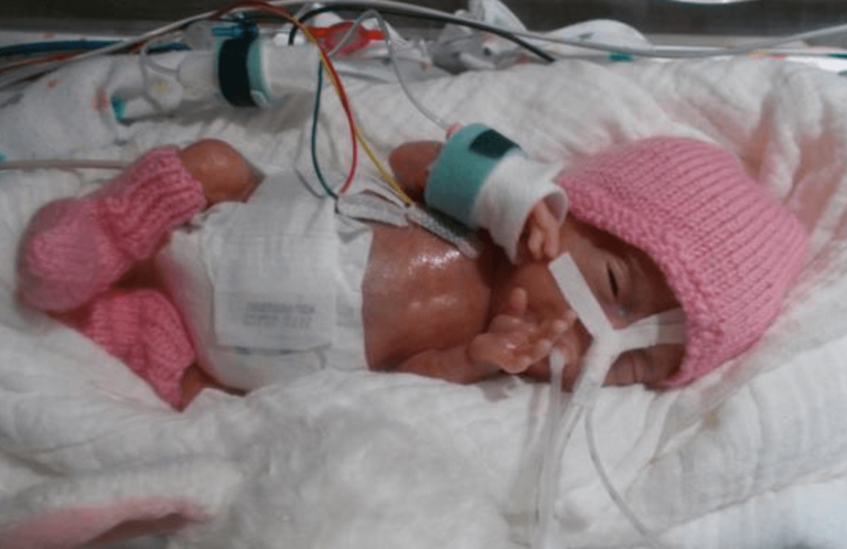 La historia de Emilia, la recién nacida más pequeña del mundo