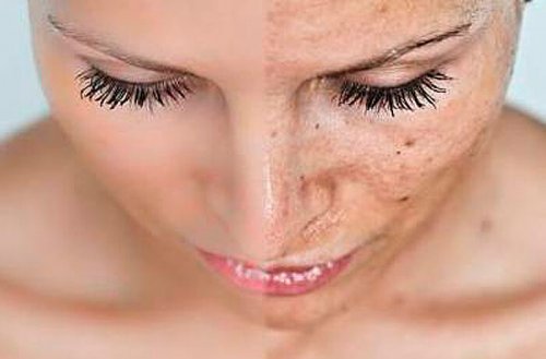 Si se producen estos cambios en la piel durante el embarazo, se debe disminuir el tiempo que se expone la piel al sol.
