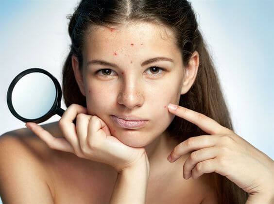 9 soluciones para el acné de tu hijo adolescente