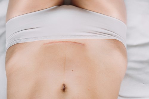 El sueño de las mujeres tras el parto es recuperar el abdomen plano de antes.