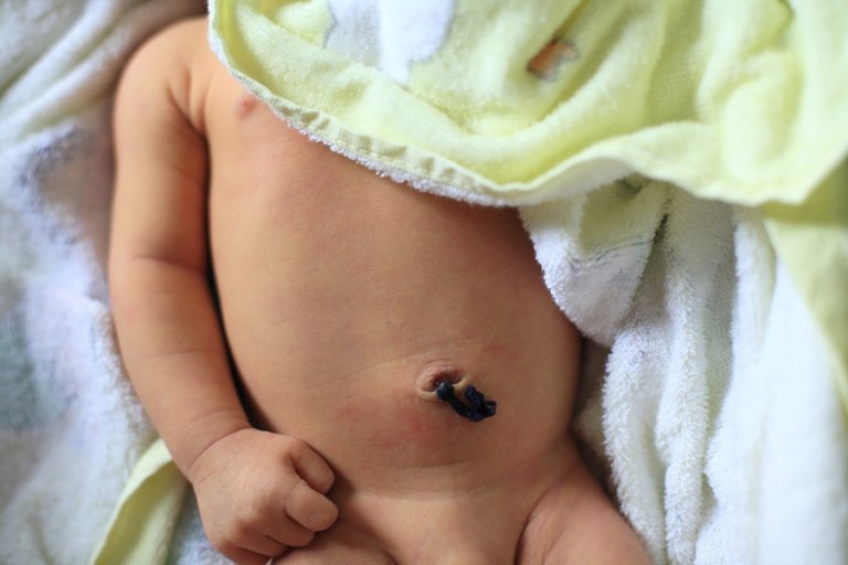 Cuidados de las infecciones del ombligo en el recién nacido