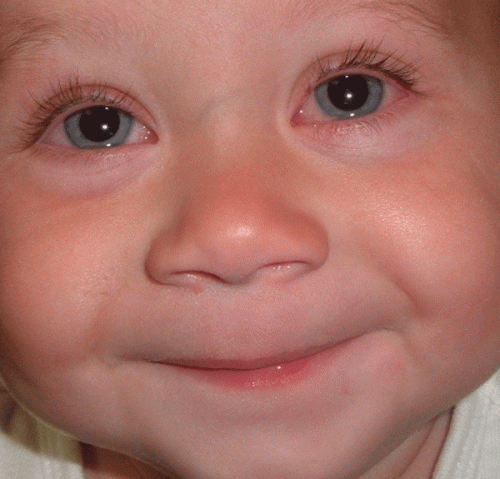 ¿Cómo tratar la conjuntivitis en los niños?