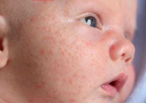 El acné en los recién nacidos es algo común en sus primeras semanas o meses de vida.