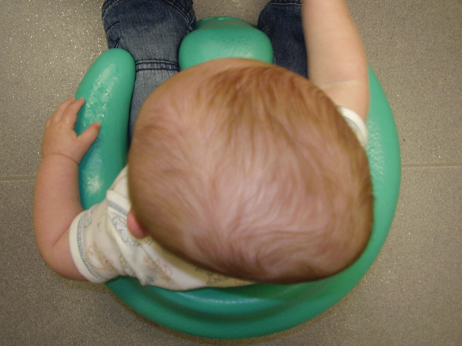 Le crâne d'un bébé qui présente le syndrome de la tête plate.