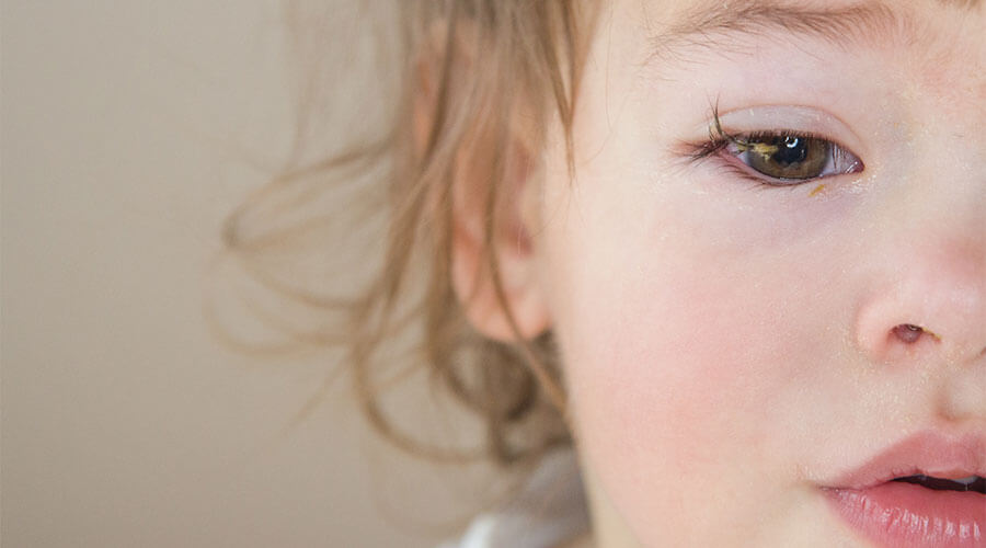 Gotas Para La Infeccion De Los Ojos En Niños