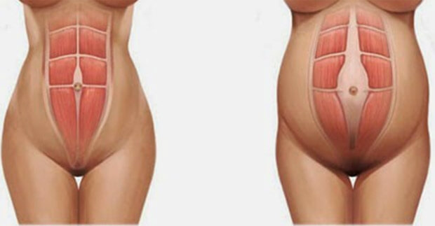 diástasis abdominal 2