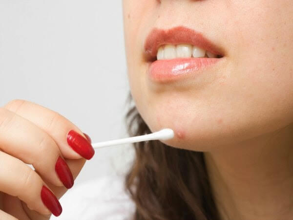 A womam touching a pimple on her chin with a cotton swab.