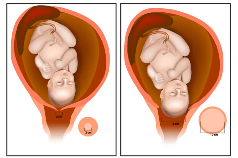 ¿Qué es el borramiento del cuello uterino?