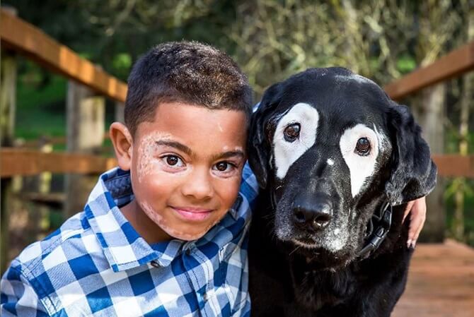 Este niño supera la depresión al conocer a un perro con la misma enfermedad