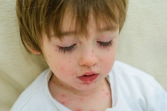 ¿Qué hacer si mi hijo tiene varicela?