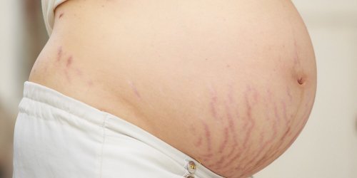 Si deseas eliminar las estrías durante el embarazo, debes ser paciente.