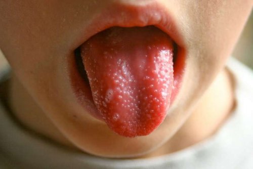 La langue d'un enfant qui a la scarlatine. 