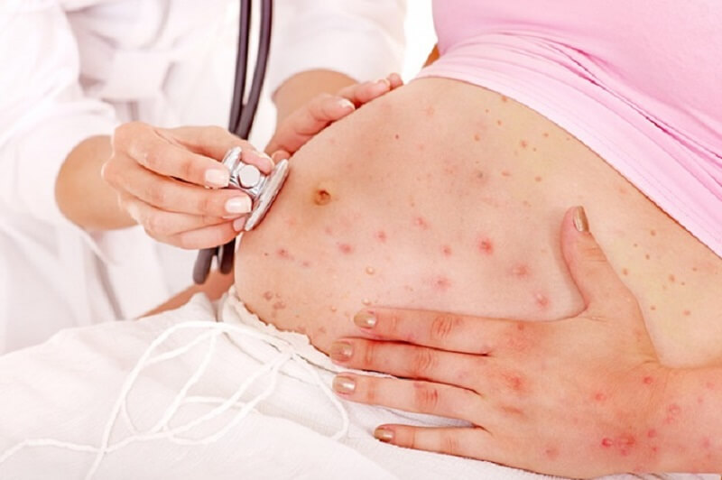 ¿Qué es la varicela congénita?