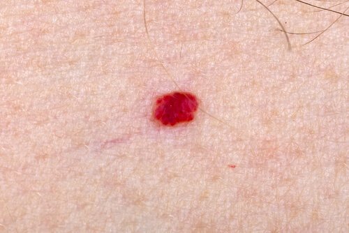 ¿Qué hago si mi hijo tiene angiomas en la piel?