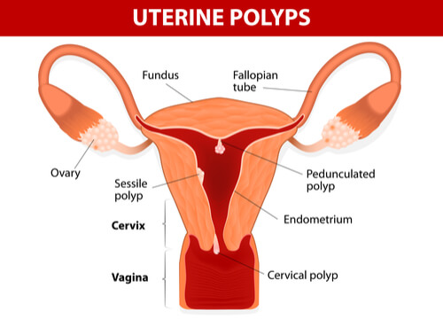 Les polypes de l'utérus sont asymptomatiques.