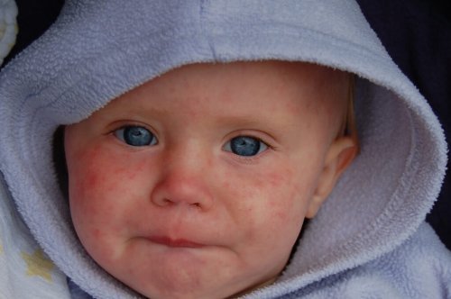 Bebé con brotes de sarampión por falta de vacunación.