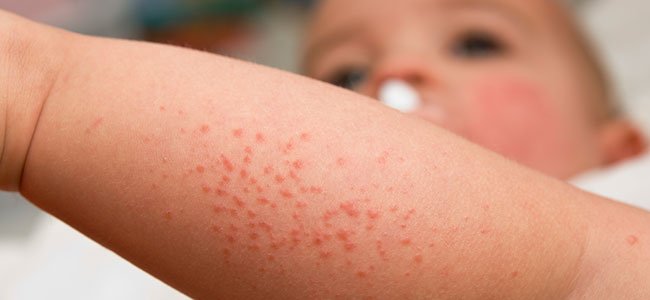 El prurito infantil es un síntoma y no una enfermedad