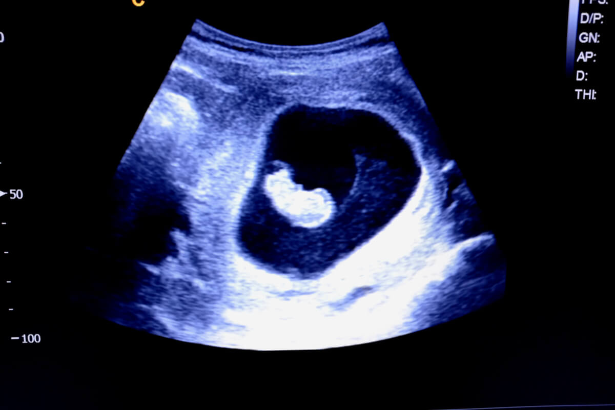 Geschlecht deines Babys - Ultraschallbild eines Fötus
