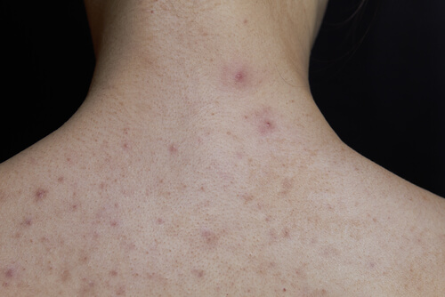 scarlatine