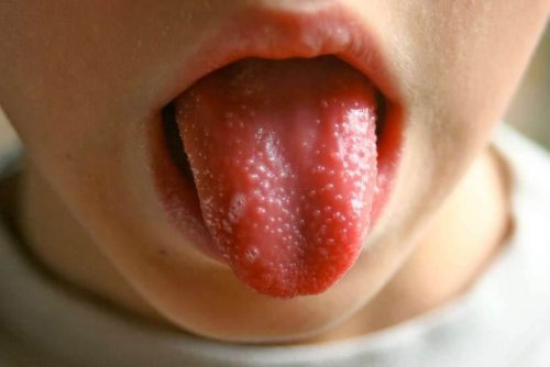 La scarlatine chez les enfants fait que la langue prend une couleur rouge foncé.