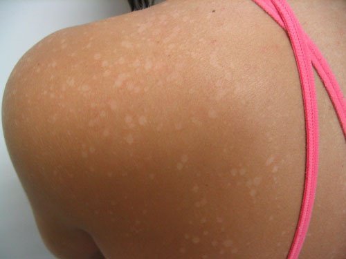 Las manchas en la piel pueden ser otro síntomas de las faltas de la regla.