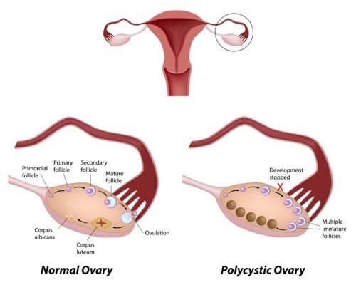 Comparaison entre un ovaire normal et un ovaire polykystique.