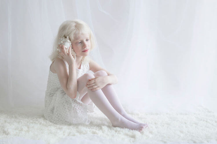 El albinismo en niños.