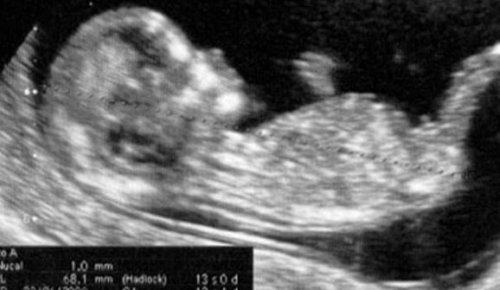 L'échographie de la 13ème semaine de grossesse.