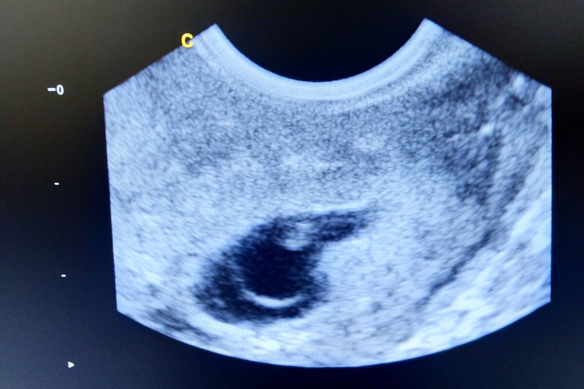 Échographie transvaginale en début de grossesse