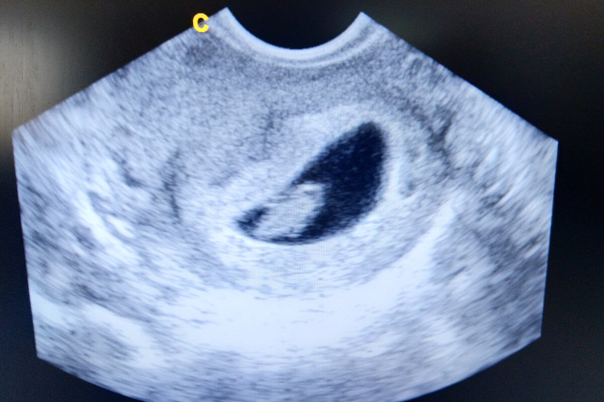 Échographie pendant la semaine 6 de la grossesse