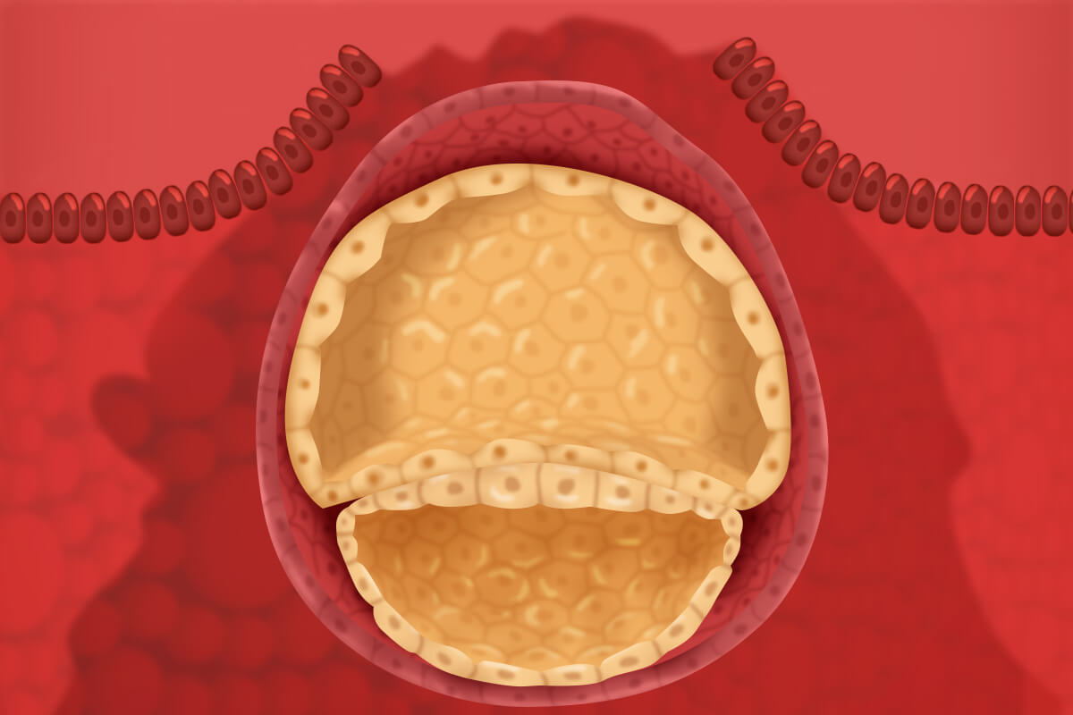 Implantation cramps.
