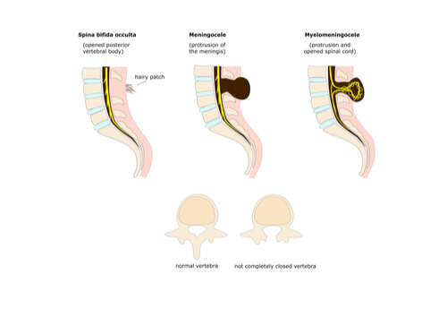 Le spina bifida est un défaut du tube neural.