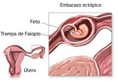 El embarazo ectópico es aquel en el que el óvulo fertilizado se implanta fuera del útero.