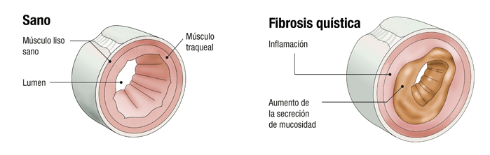 La fibrosis quística.