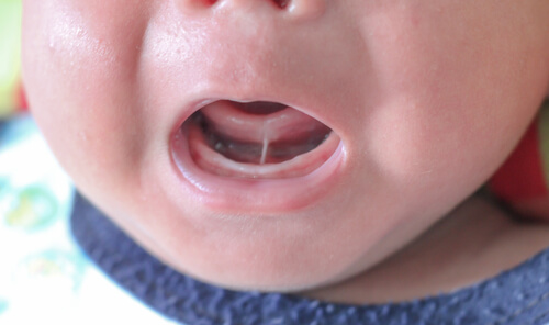Anquiloglosia o frenillo lingual corto en niños