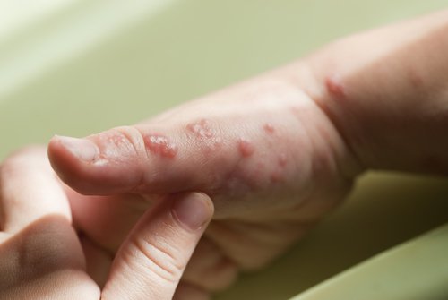 El herpes no tiene cura definitiva.