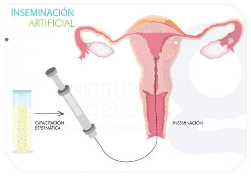 La inseminación artificial persigue que la mujer logre quedarse embarazada.