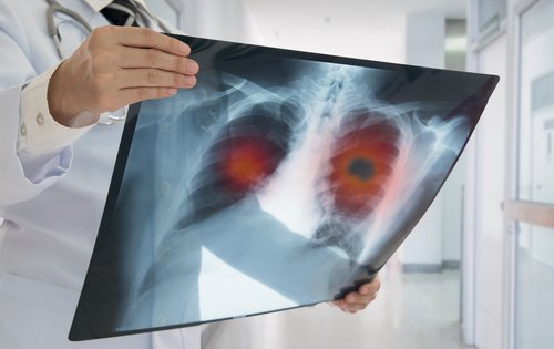 Rayos X para examinar los pulmones.
